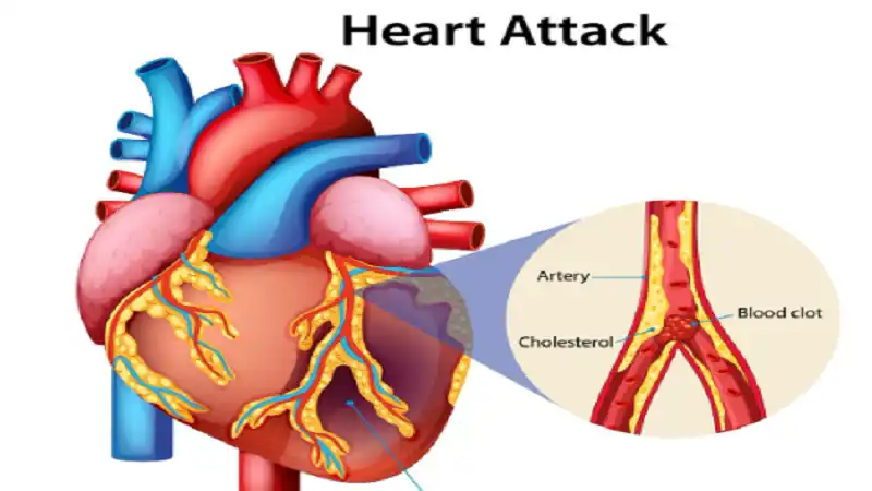 supraventricular tachycardia