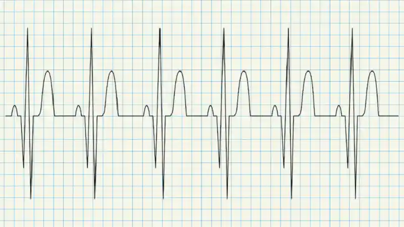 supraventricular ectopy