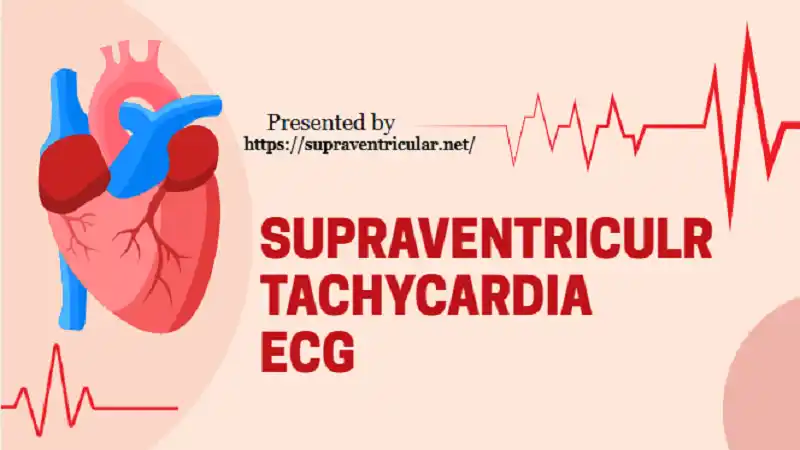 Supraventricular Tachycardia ECG