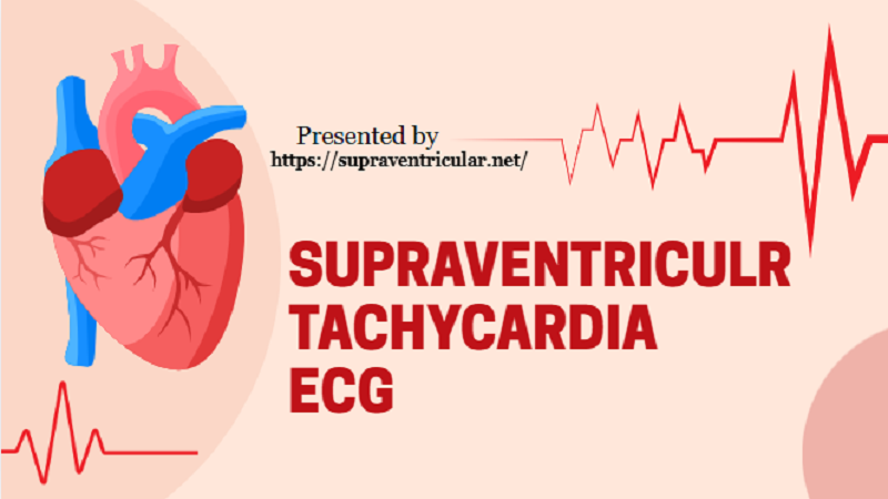 Supraventricular Tachycardia ECG