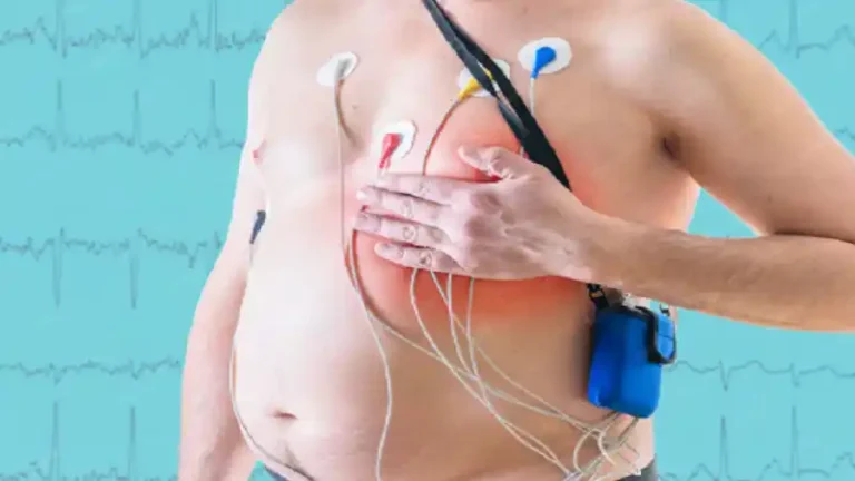 Paroxysmal Supraventricular Tachycardia